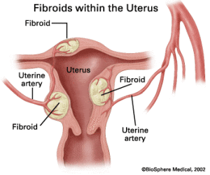 How fibroids grow in your body. (Office on Women's Health)
