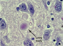 Lewy bodies in the brain. (Photo: Alzheimer's Association)
